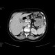 Carcinoma of the lienal flexure: CT - Computed tomography